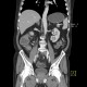 Ulcerative colitis, enterography: CT - Computed tomography