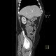 Ulcerative colitis, enterography: CT - Computed tomography