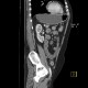 Ulcerative colitis, enterography: CT - Computed tomography
