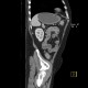 Ulcerative colitis, enterography: CT - Computed tomography