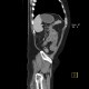 Ulcerative colitis, enterography: CT - Computed tomography