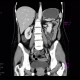 Ulcerative colitis, enterography: CT - Computed tomography