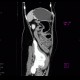 Ulcerative colitis, enterography: CT - Computed tomography