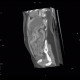 Ulcerative colitis, enterography: CT - Computed tomography