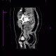 Ulcerative colitis, enterography, CPR: CT - Computed tomography
