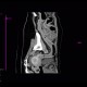 Ulcerative colitis, enterography, CPR: CT - Computed tomography