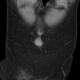 Umbilical metastasis, Sister Mary Joseph syndrome: CT - Computed tomography