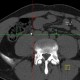 Ureterolithiasis: CT - Computed tomography