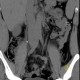 Ureterolithiasis: CT - Computed tomography