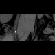 Ureterolithiasis: CT - Computed tomography