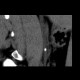 Ureterolithiasis: CT - Computed tomography