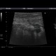 Acute appendicitis: US - Ultrasound