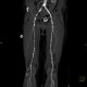 Occlusion of iliac artery, collateral blood flow: CT - Computed tomography