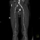 Occlusion of iliac artery, collateral blood flow: CT - Computed tomography