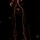 Occlusion of iliac artery, collateral blood flow: CT - Computed tomography