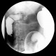Ulcerative colitis, barium enema, irrigography: RF - Fluoroscopy