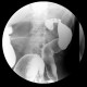 Ulcerative colitis, barium enema, irrigography: RF - Fluoroscopy