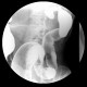 Ulcerative colitis, barium enema, irrigography: RF - Fluoroscopy