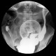 Ulcerative colitis, barium enema, irrigography: RF - Fluoroscopy