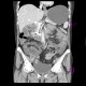 Ulcerative colitis of left colon, enterography: CT - Computed tomography