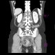Ulcerative colitis of left colon, enterography: CT - Computed tomography