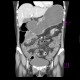 Ulcerative colitis of left colon, enterography: CT - Computed tomography