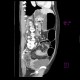 Ulcerative colitis of left colon, enterography: CT - Computed tomography