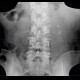 Ureterolithiasis, urolithiasis, hydronephrosis, grade II: X-ray - Plain radiograph