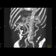 Obliteration of the coeliac trunk and superior mesenteric artery, massive collateral flow: CT - Computed tomography