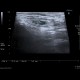 Reactive lymph nodes in interferon treatment: US - Ultrasound
