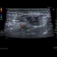 Reactive lymph nodes in interferon treatment: US - Ultrasound