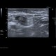 Reactive lymph nodes in interferon treatment: US - Ultrasound