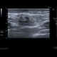 Reactive lymph nodes in interferon treatment: US - Ultrasound