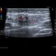 Reactive lymph nodes in interferon treatment: US - Ultrasound