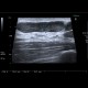 Lymph node, inflammatory, groin: US - Ultrasound