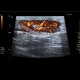 Lymph node, inflammatory, groin: US - Ultrasound