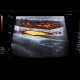 Lymph node, inflammatory, groin: US - Ultrasound