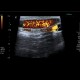 Lymph node, inflammatory, groin: US - Ultrasound