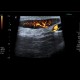 Lymph node, inflammatory, groin: US - Ultrasound