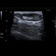Lymph node, inflammatory, groin: US - Ultrasound