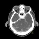 Venous angioma of cerebellum: CT - Computed tomography