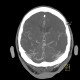 Venous angioma of cerebellum: CT - Computed tomography