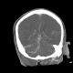 Venous angioma of cerebellum: CT - Computed tomography
