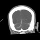 Venous angioma of cerebellum: CT - Computed tomography