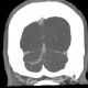 Venous angioma of cerebellum: CT - Computed tomography
