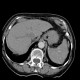 Calcifications in spleen, miliary calcifications, tuberculosis: CT - Computed tomography