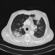 Pulmonary infiltrates, pleural effusion: CT - Computed tomography