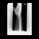 VISI, volar intercalated segment instability: X-ray - Plain radiograph