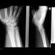 VISI, volar intercalated segment instability: X-ray - Plain radiograph