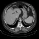 Detector malfunction: CT - Computed tomography